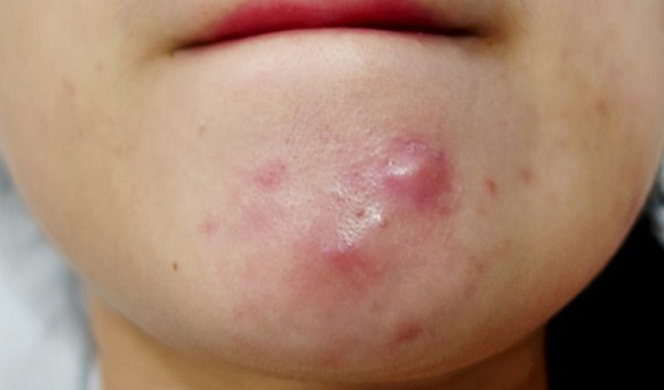 Nguyên nhân gây mụn bọc và cách trị mụn bọc hiệu quả