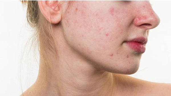Nguyên nhân gây mụn do nội tiết tố