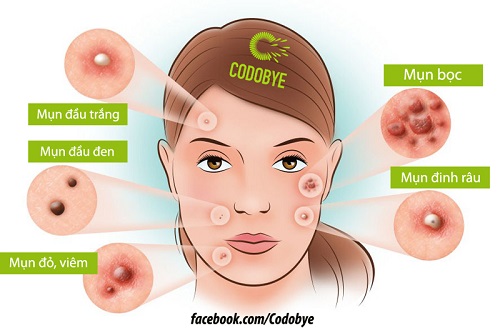 Nhận biết các loại mụn thường gặp