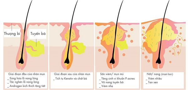 Quá trình hình thành mụn bọc
