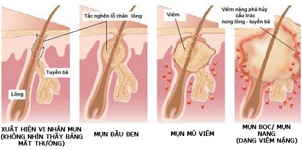 Rối loạn nội tiết tố ở tuổi mới lớn gây mụn bọc