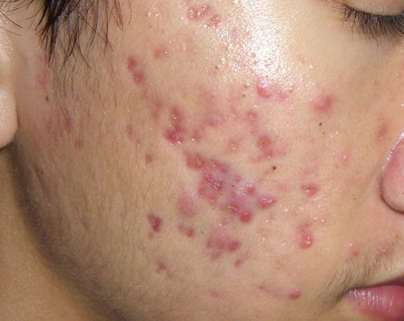Sẹo mụn thông thường được hình thành từ các tổn thương viêm sưng