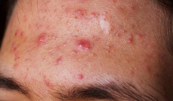 Tại sao mụn lại nổi nhiều trên trán?