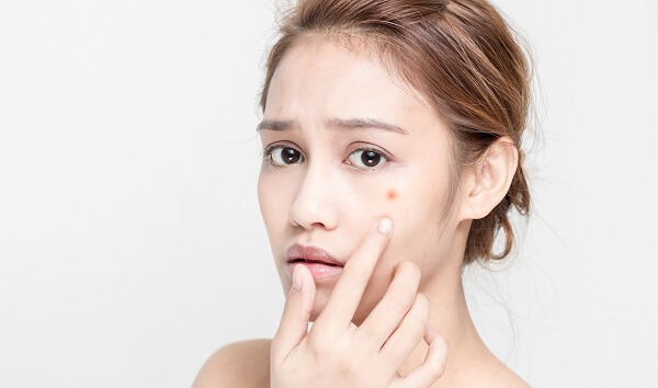 Tâm sự: Bạn đã bao giờ bị ám ảnh vì mụn trong suốt khoảng thời thanh xuân của mình chưa?