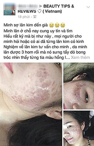 Tiền mất tật mang do sử dụng lăn kim để trị mụn