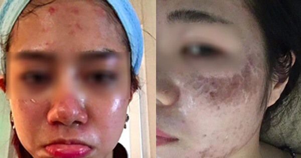 Trị mụn trứng cá vô tội vạ, hậu quả khôn lường
