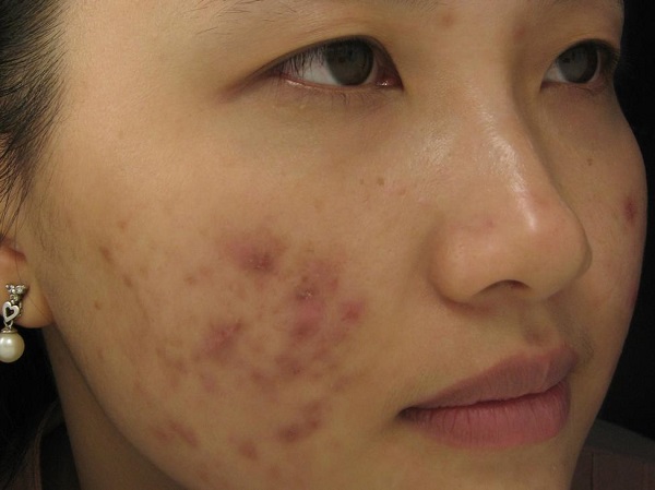 Viên uống trị mụn trứng cá CODOBYE có dành cho các bạn bị mụn lâu năm không?